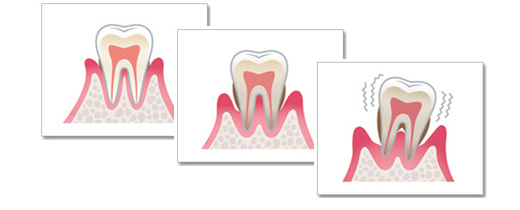 歯周病段階
