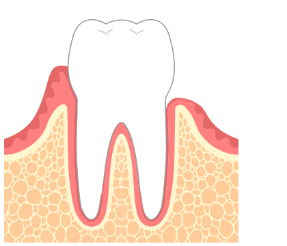 歯周病症例イメージ