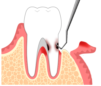 歯周病治療フラップオペ