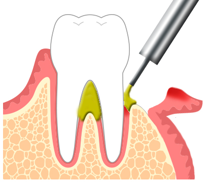 歯周病治療再生法