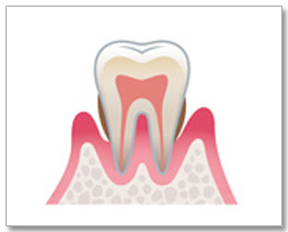 歯周病中期症状イラスト